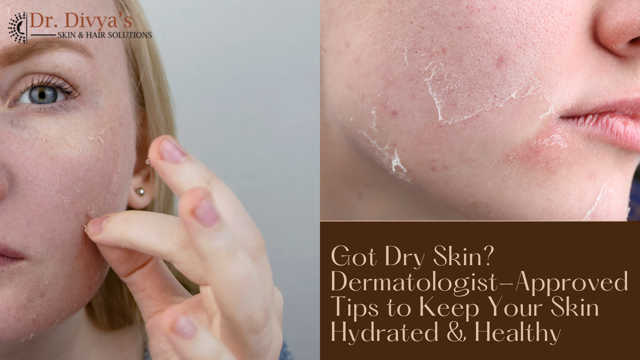 Dry Skin