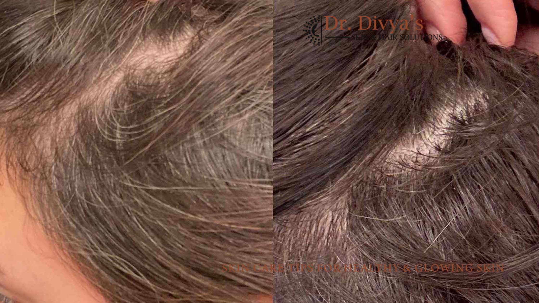 Causes of Hair Loss and How to Prevent It