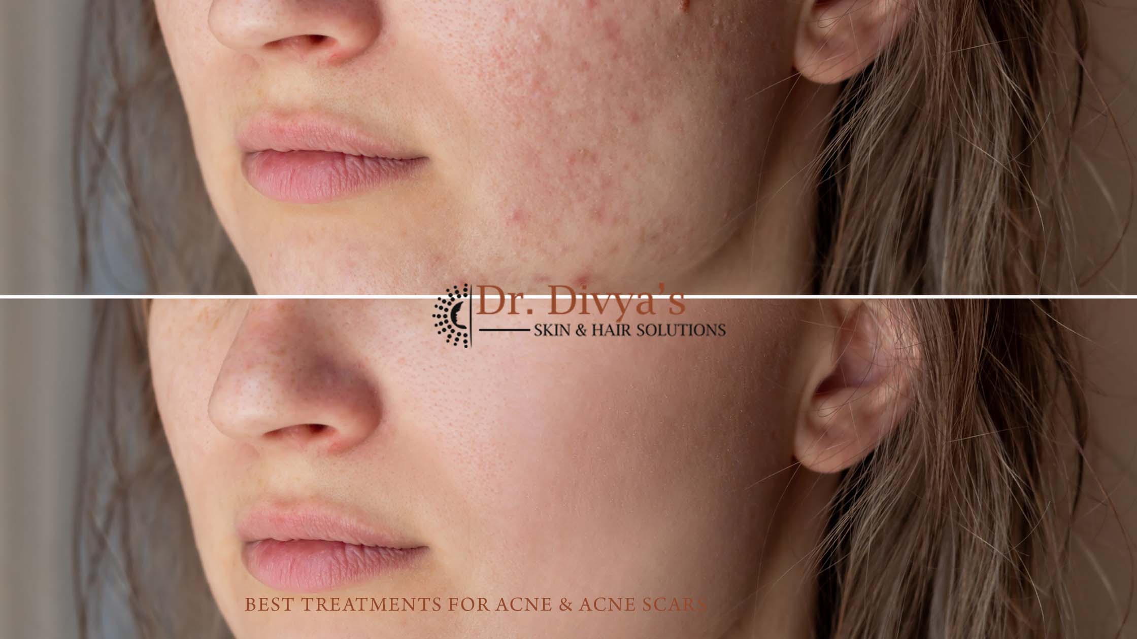 Best Treatments for Acne & Acne Scars