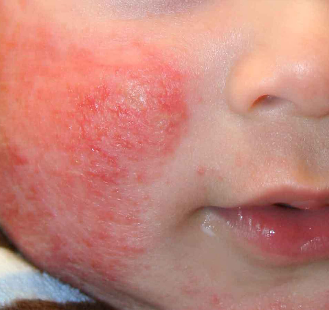 Common skin rashes in babies