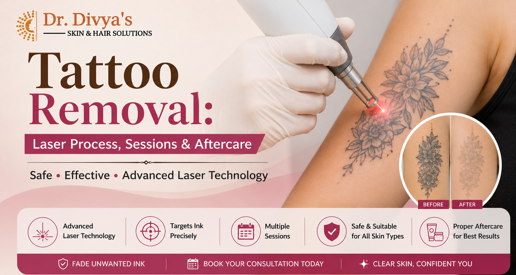 Tattoo Removal: Laser Process, Sessions & Aftercare
