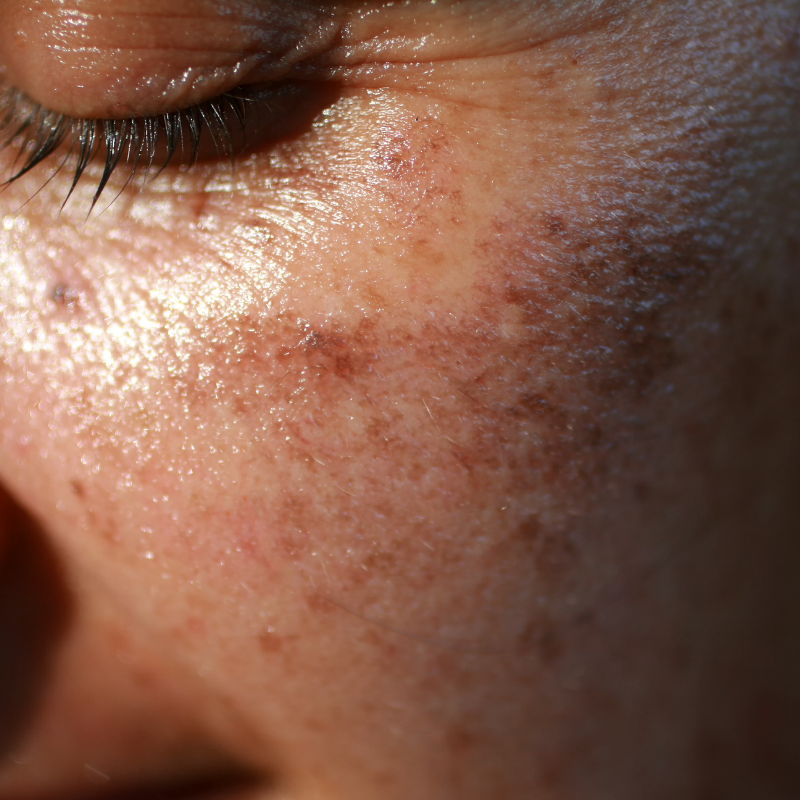 Get rid of dark spots, body acne,stretch marks hyperpigmentation
