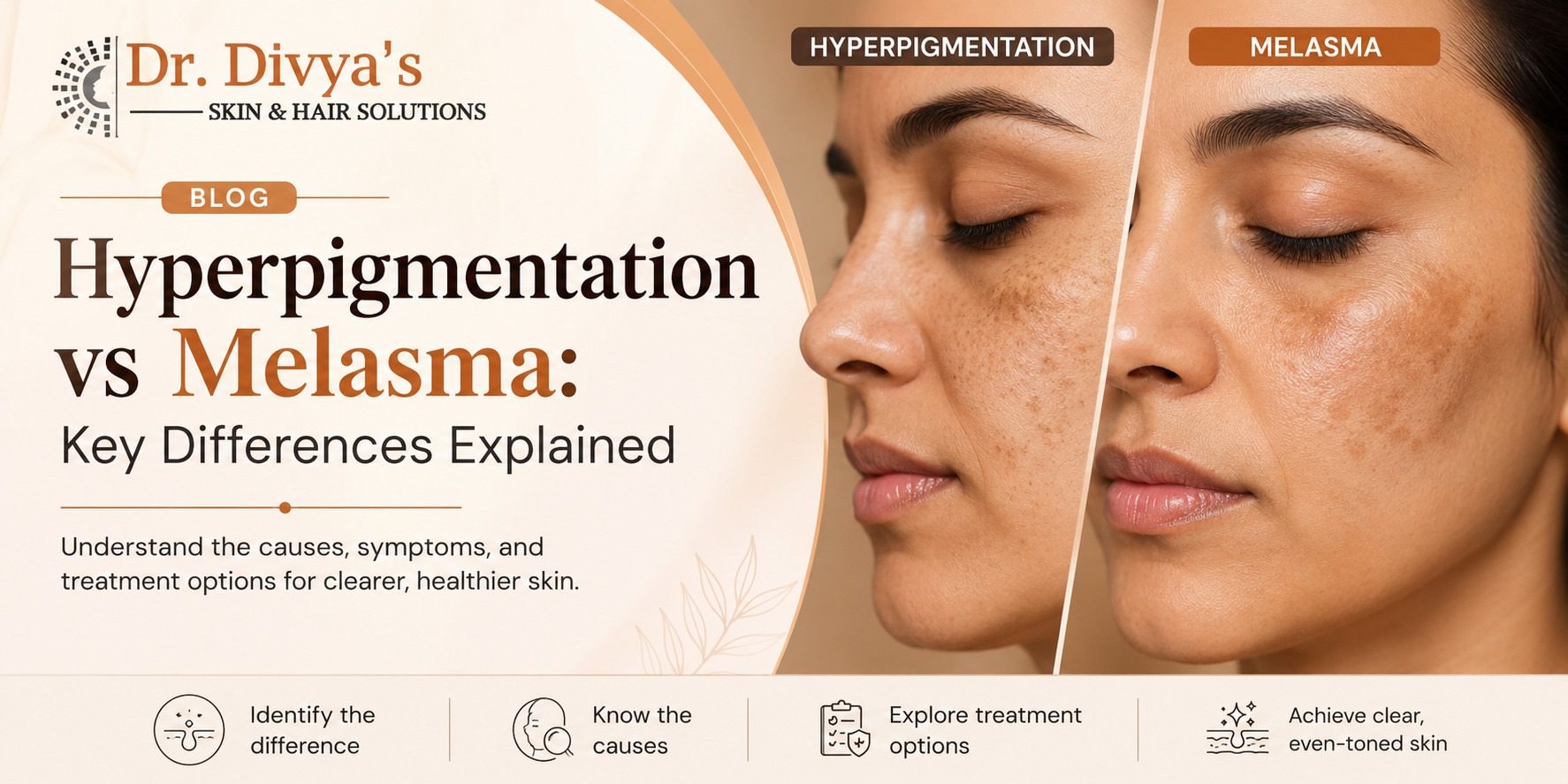 Hyperpigmentation vs Melasma
