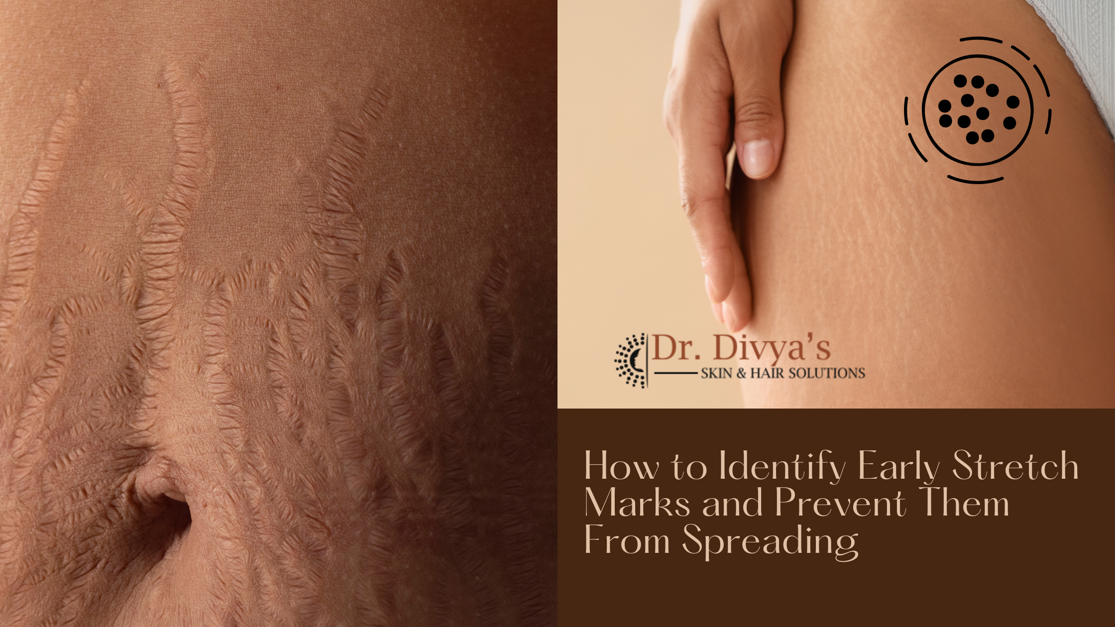Early Stretch Marks
