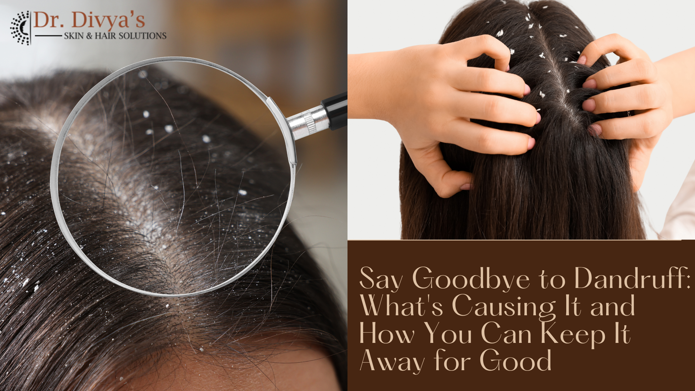 Say Goodbye to Dandruff