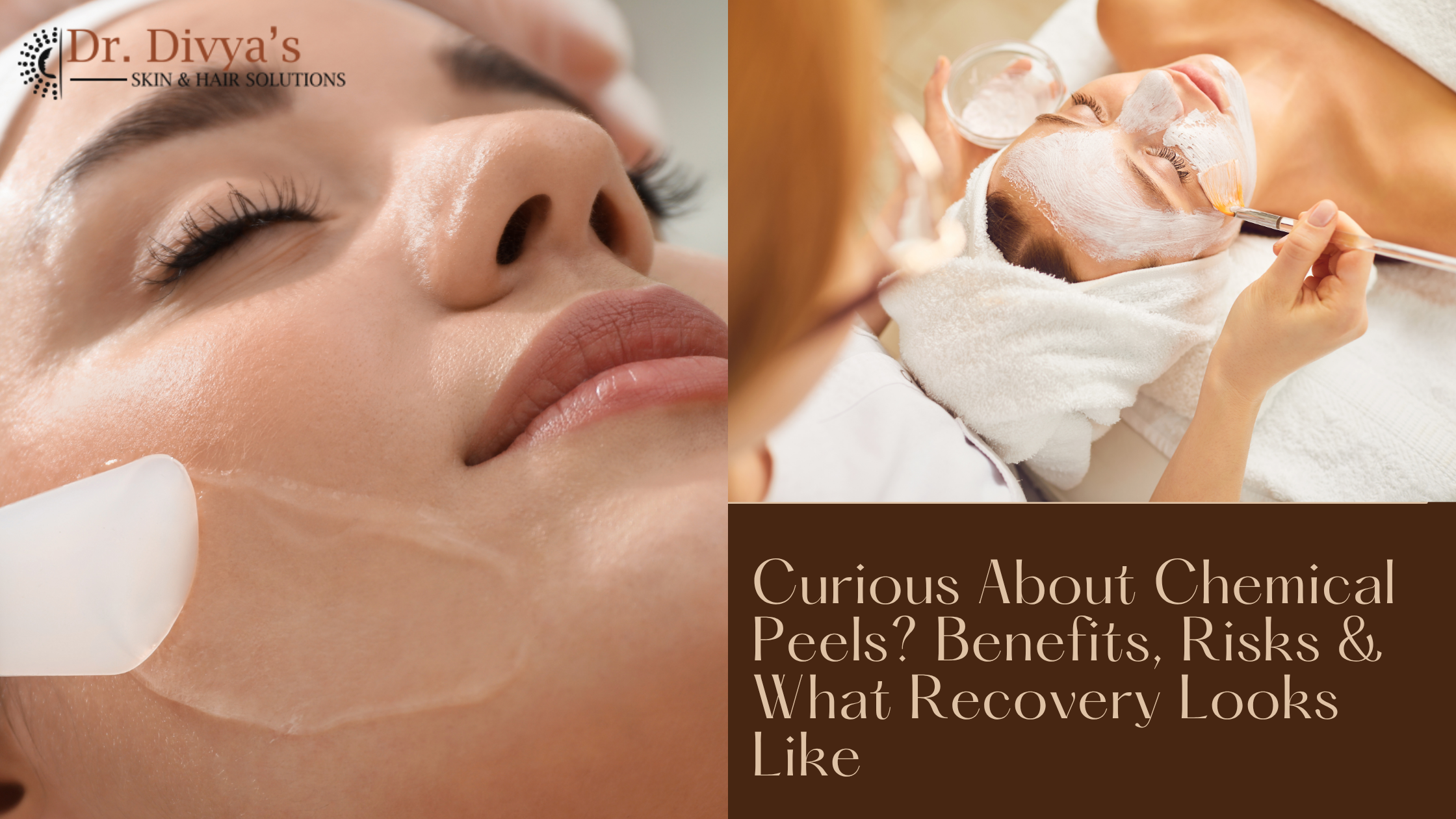 chemical peels